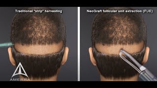 NeoGraft hair transplant procedure  animation [upl. by Ariat311]