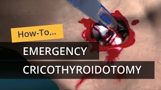 Emergency Cricothyroidotomy using CricKey [upl. by Odarbil]