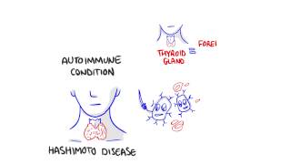 Some facts about Hashimotos disease [upl. by Nannarb]