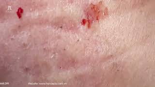 Big Cystic Acne Blackheads Extraction Blackheads amp Milia Whiteheads Removal Pimple Popping [upl. by Lerak496]