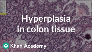 Hyperplasia in colon tissue  Gastrointestinal system diseases  Health amp Medicine  Khan Academy [upl. by Neleb151]