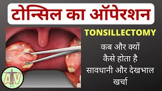 टोन्सिल का ऑपरेशन कब और क्यों   tonsillectomy in hindi  tonsil surgery  tonsillitis treatment [upl. by Haskins]