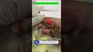 Pyogenic granuloma laser treatment  red bump on sole  pyogenic granuloma का इलाज़ Dr Uttam Lenka [upl. by Tsyhtema]