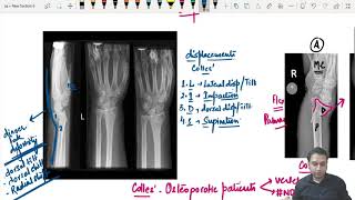 Colles fracture  Reduction and plaster application [upl. by Coco]