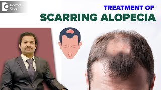 SCARRING ALOPECIA Treatment  Patchy Hair Loss amp Hair RegrowthDrDeepak P Devakar Doctors Circle [upl. by Eiffub466]