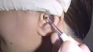 Curly Ear Wax Removal Up Close [upl. by Spurgeon]