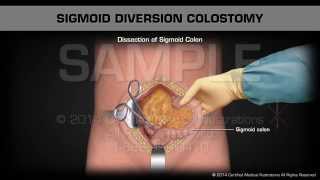 Sigmoid Diversion Colostomy [upl. by Ibob519]