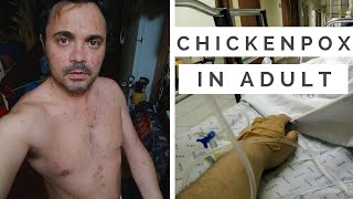 CHICKENPOX IN ADULT  Varicella my experience [upl. by Amliw]