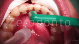 Torque management accomplished with a bracketless fixed orthodontic appliance [upl. by Essyle]