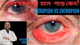 🔴 ECTROPION IN OPTHALMOLOGY VS ENTROPION IN OPTHALMOLOGY  IN BANGLA চোখের পাতা ফুলে গেলে করণীয় [upl. by Kavanaugh]