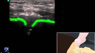 How To Ultrasound Guided Injection of the Pubic Symphysis 3D Video [upl. by Bouchard]