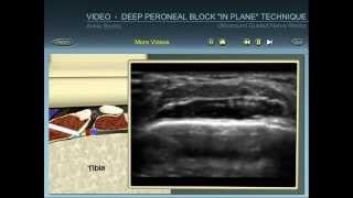 ankle block deep peroneal nerve ultrasound guided block quotin planequot technique [upl. by Iroj]