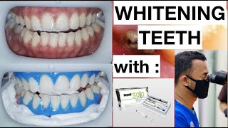 Dental Whitening Procedure Natural Bright Smile with Beyond Kit  General Dentist Griya RR [upl. by Haronid996]