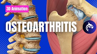 Understand Osteoarthritis  OA of the Knee Spine Hip Hand Elbow and more [upl. by Nylhtak]