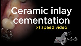 Ceramic inlay cementation procedure X1 speed 세라믹 인레이 세팅 과정 [upl. by Wallie]