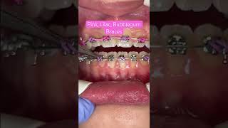 Pink Lilac Bubblegum Braces braces orthodontics [upl. by Renwick]