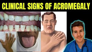 Doctor explains signs amp symptoms of Acromegaly gigantism including prognathism frontal bossing [upl. by Niloc]