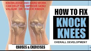 KNOCK KNEES OR GENU VALGUM FOR RUNNERS [upl. by Waylin685]