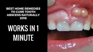 how to drain a tooth abscess at home home remedies for tooth abscesstooth abscess pain relief fast [upl. by Rosner]