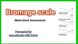 Bromage scale  motor block Assessment anaesthesiawithbabar2576 short [upl. by Nessah]