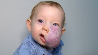 See 2YearOlds Incredible Transformation After Surgery To Remove Facial Tumor [upl. by Inar102]