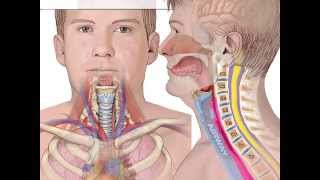 Complications of ACDF  Hematoma Formation  Airway Obstruction  Colorado Spine Surgeon [upl. by Caron31]