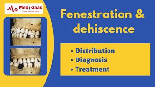 Fenestration and Dehiscence l Periodontal anatomy l Mediklaas [upl. by Quentin]