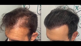 Trasplante Capilar  Hair Transplant  Dra Ximena Vila 2552 Grafts [upl. by Assiar]