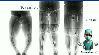 Blount’s Disease•What is important in Blount’s  A Cherkashin [upl. by Neemsay]