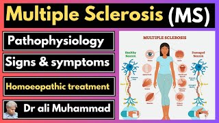 Multiple sclerosis pathophysiology signs amp symptoms Homeopathic treatment Dr ali muhammad [upl. by Aynod]