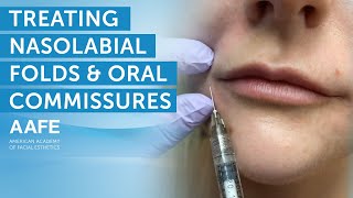 Using Dermal Fillers to Fill and Smooth Smile Lines  AAFE [upl. by Ares]