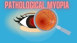 Pathological Myopia  High Myopia  Ophthalmology Lecture [upl. by Ambrogio]