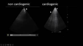 Great role of US in diffrentiating between cardiogenic and non cardiogenic pul edema [upl. by Alamak586]