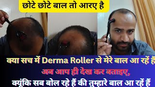 आज मैं आप सब को दिखाता हूं Derma Roller के 6 Month इस्तेमाल करने का Result  Derma Roller results [upl. by Denver]