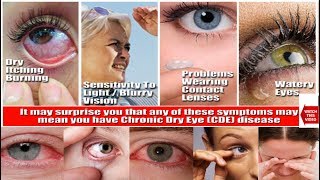 5 Natural Treatments for Dry Eyes Eye Doctor Explains [upl. by Nalat]