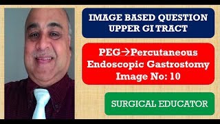 PERCUTANEOUS ENDOSCOPIC GASTROSTOMY UPPER GI TRACT Image Based Question [upl. by Jacques79]