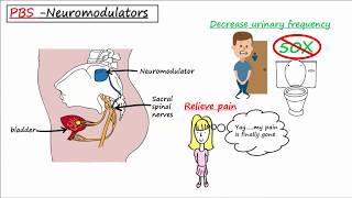 Painful Bladder Syndrome PBS  Interstitial Cystitis IC [upl. by Perlie]