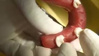 Video 8 Pulp Extirpation from Primary Teeth Using Broach [upl. by Aseefan]