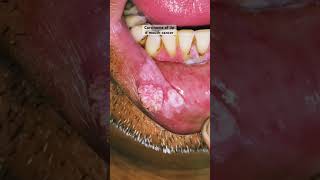 Lip Cancer  Mouth Cancer  Oral Squamous cell Carcinoma ytshorts [upl. by Isyad117]