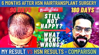 6 Months HSN Hair Transplant Results Oct2021 Result Comparison hsn ameerht hairtransplanttamil [upl. by Filide]