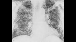 FIBROSIS PULMONAR CAUSAS SÍNTOMAS DATOS CLÍNICOS IMÁGENES Y TRATAMIENTO [upl. by Quirita]