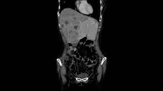 meta liver dt breast cancer [upl. by Siurtemed]