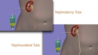 Your Nephrostomy or Nephroureteral Drain [upl. by Anitrak]