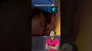 Tapón de cerumen 😰 [upl. by Miehar]