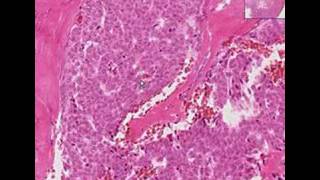 Histopathology OvaryGranulosa cell tumor [upl. by Bonnice602]