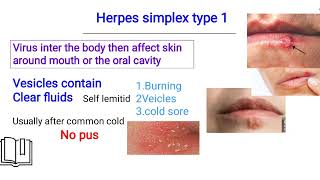 herpes simplex infection الهيربس [upl. by Htesil]