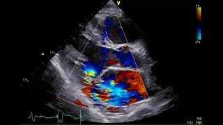 経胸壁心エコー図 急性僧帽弁逆流症 MR 2 左室長軸像カラードプラ [upl. by Nissy]