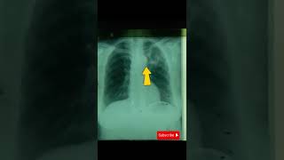 cavitary lesion due to pulmonary TBstudywithme shorts shortsvideo shortsfeed tb pulmonarytb [upl. by Leraj]