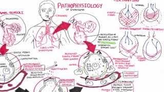 Emphysema  Pathophysiology COPD [upl. by Eedna508]