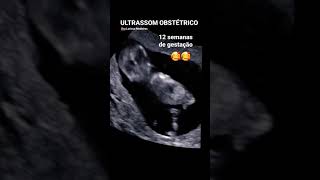 12 SEMANAS DE GESTAÇÃO mexendo muito 😆  Ultrassom obstétrico [upl. by Nicole]